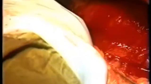 Расширенная субтотальная дистальная резекция желудка