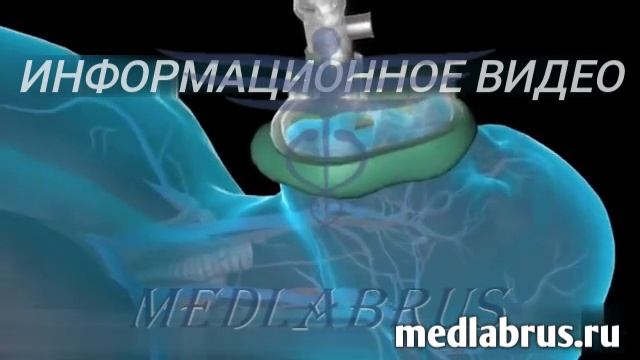 Общая анестезия