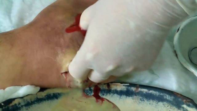Гнойный туберкулез стопы. смотреть онлайн