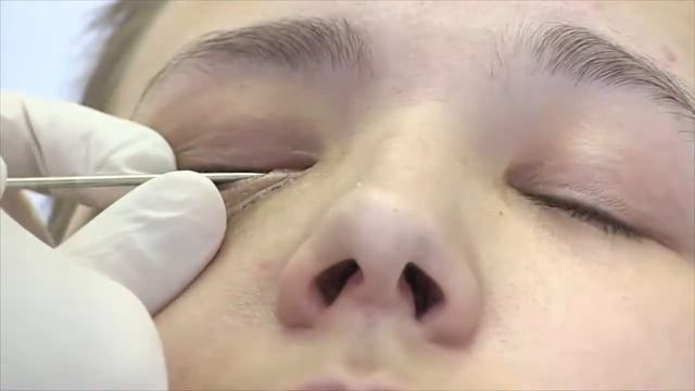 Промывание слезоотводящих путей смотреть онлайн