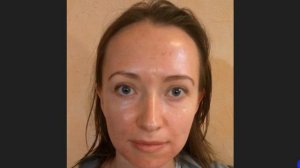 Пилинг Джеснера. День 3