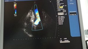 Динамическая обструкция выносящего тракта левого желудочка