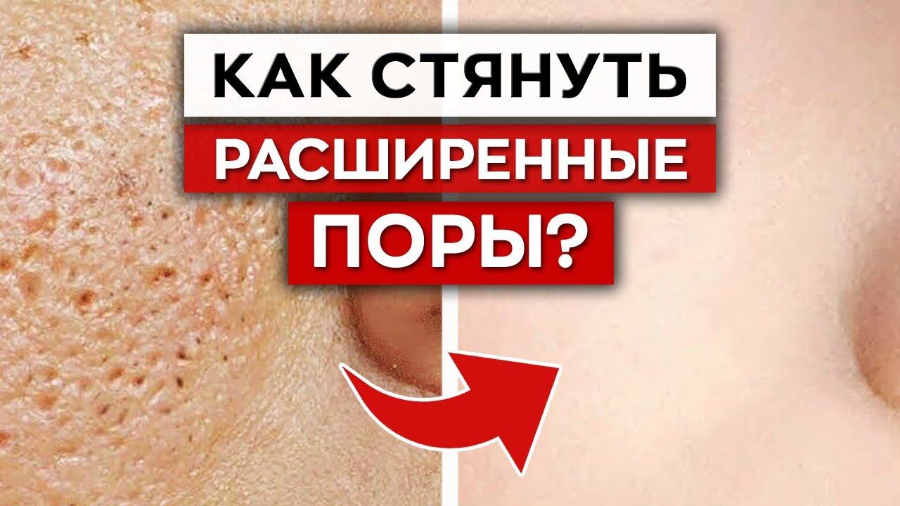 Как бороться с расширенными порами? / Как ухаживать за жирной кожей лица?