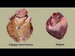 Необратимые Алкогольные Изменения