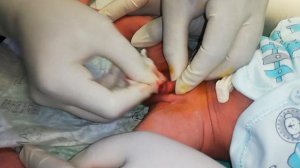 Circumcision | Non Surgical-Plastibell Technique | Circumcision in Baby | Surgeon Dr Imtiaz Hussain