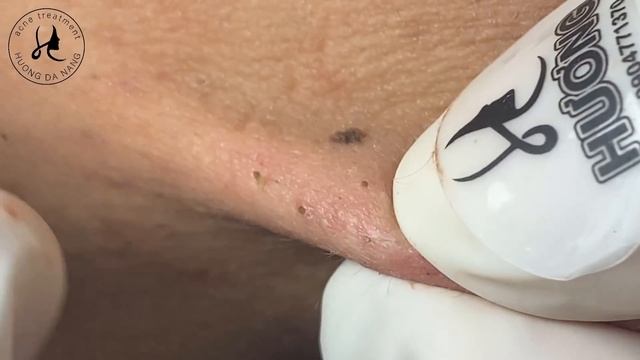 Huong Da Nang Acne Treatment #355 смотреть онлайн