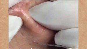 Удаление чёрных точек и прыщей #10