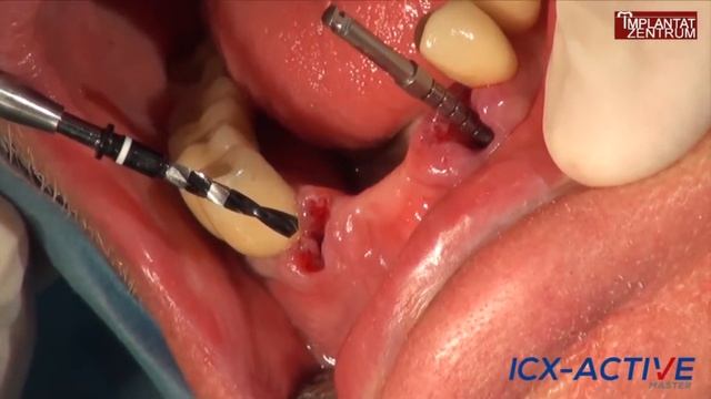 ICX-Active-Master: Одномоментная имплантация. Установка мостовидного протеза смотреть онлайн