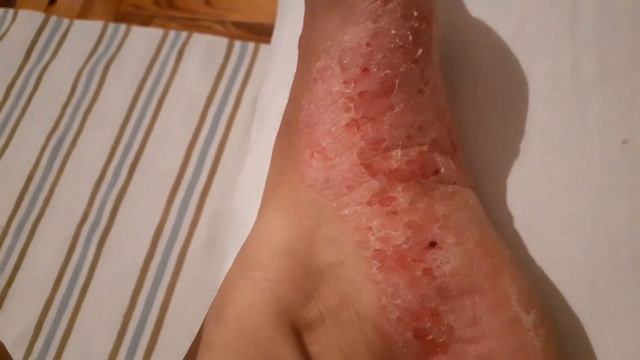 СУХАЯ ЭКЗЕМА СТОП КАК ПРОТЕКАЕТ БОЛЕЗНЬ