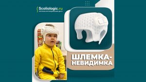 Ортопедический шлем при плагиоцефалии