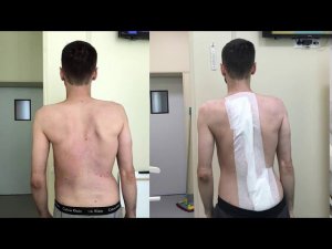 Отзыв пациента 37 лет после коррекции сколиоза