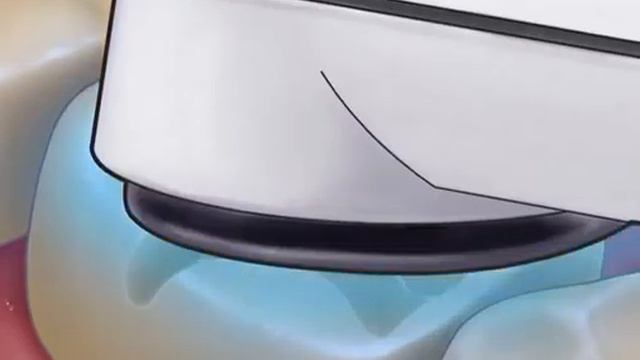 пломбирование зуба . постановка пломбы смотреть онлайн