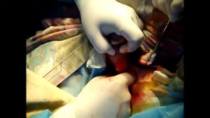 Giant Papilloma!!! Огромная папиллома!!!