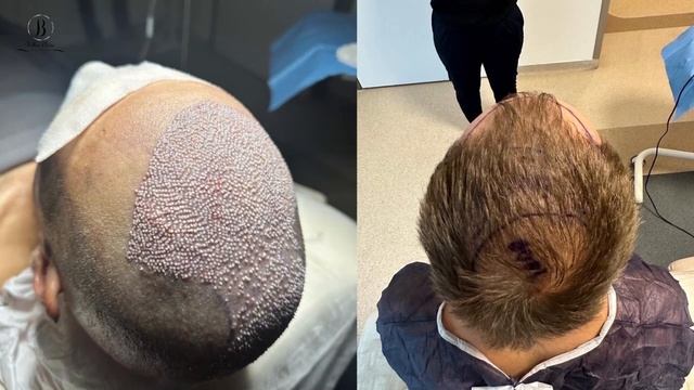 Пересадка 4500 графтов за один сеанс смотреть онлайн