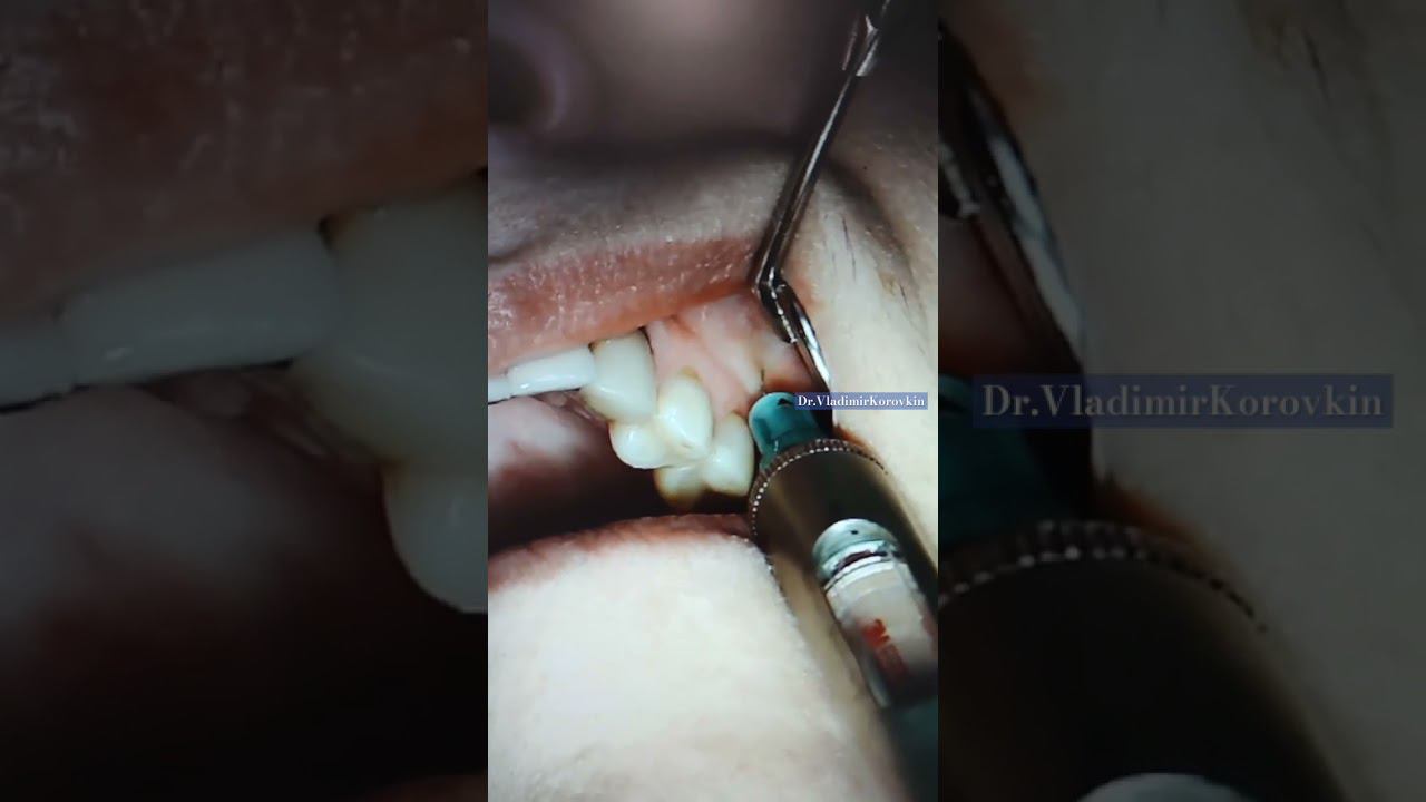 #infiltration #anaesthesia for treatment 24,24th teeth .#localanesthesia