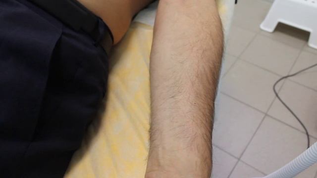 Лазерная коагуляция сосудистых звездочек