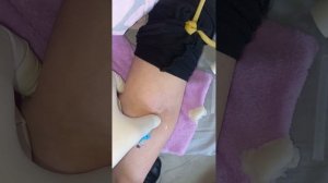 Венозная порт-система (венозный порт). установка венозного катетера