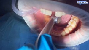 Препарирование зуба под коронку/tooth preparation