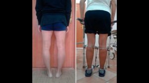Исправление кривых ног