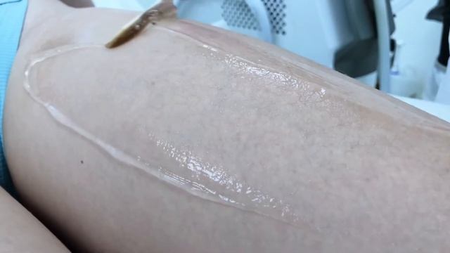 Лазерная эпиляция бёдер смотреть онлайн