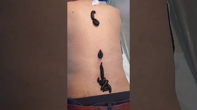 Лечение пиявками Бишкек.Мунарбек Саипов 0708105040. смотреть онлайн