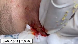 ВЫДАВЛИВАНИЕ ПРЫЩЕЙ 😍 ПРЫЩИ НА ЛИЦЕ 😍 #asmr #acne #прыщи