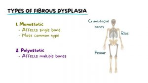 Understanding Fibrous Dysplasia: Causes, Diagnosis, Types, and Management