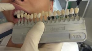 Подбор цвета зубов