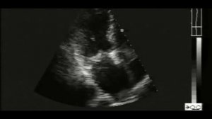 Бактериальный эндокардит с поражением задней митральной створки