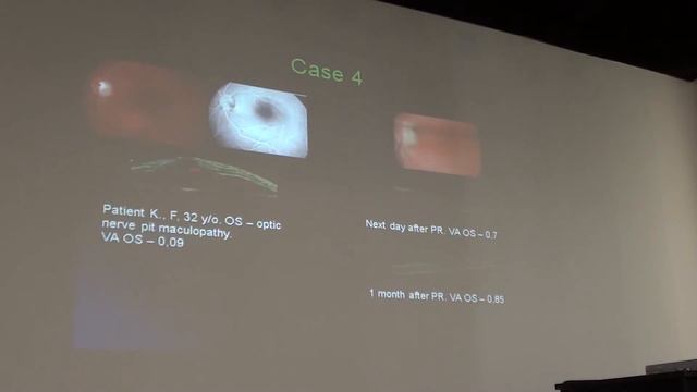 Особенности отслойки сетчатки при редких врожденных аномалиях зрительного нерва. смотреть онлайн