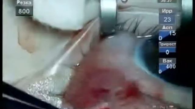Хирургия глаза  Репозиция клапана Ахмед