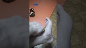 Перелом голеностопа с двух сторон