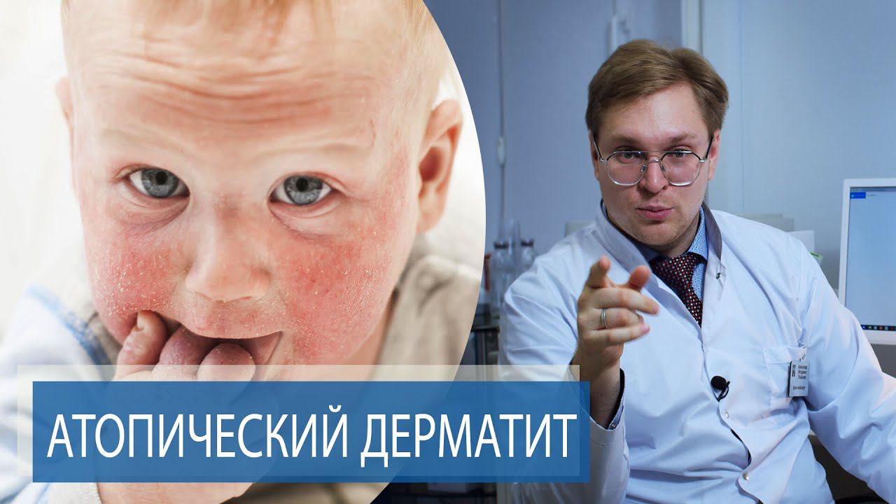 АТОПИЧЕСКИЙ ДЕРМАТИТ | Как лечить ДИАТЕЗ смотреть онлайн