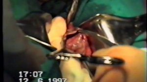 Кистэктомия №6  Разрыв кисты яичника