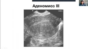 аденомиоз.mp4