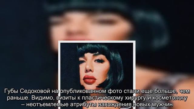 Алименто-откачка: Седокова уродует себя пластикой ради четвертого отца для ребенка