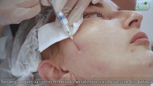 Контурная пластика РАДИЕС