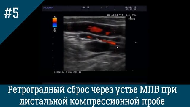 УЗИ Вен. Ретроградный сброс через устье МПВ при дистальной компрессионной пробе.