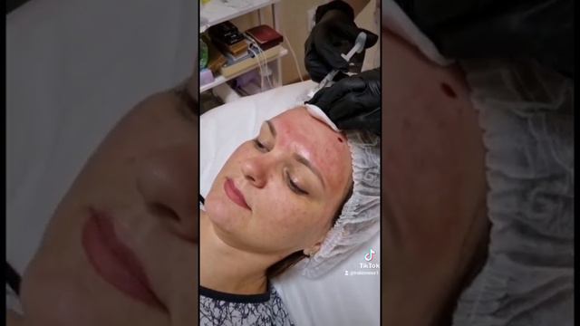 Как делают уколы красоты?