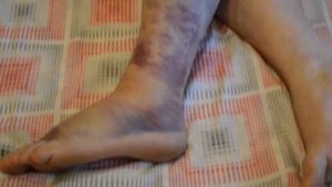 Растяжение и частично разрыв связок голеностопного сустава. Синяк до колена.