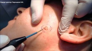 Диспластический папилломатозный невус кожи левой щеки. Хирургия Сургитронром