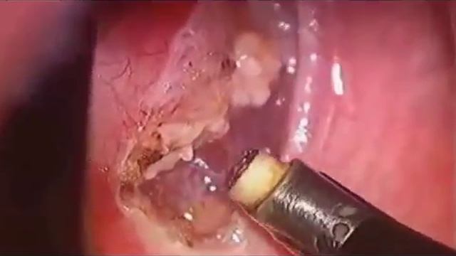 Коблация миндалин видео.mp4 смотреть онлайн