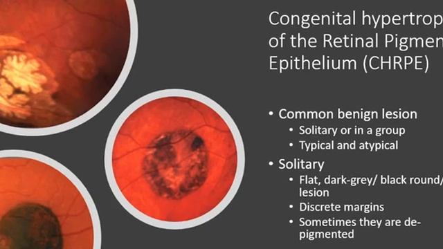 Опухоли глаза смотреть онлайн