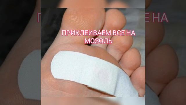 УДАЛЕНИЕ МОЗОЛЕЙ