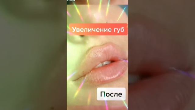 Увеличение губ. Силуэт 3D