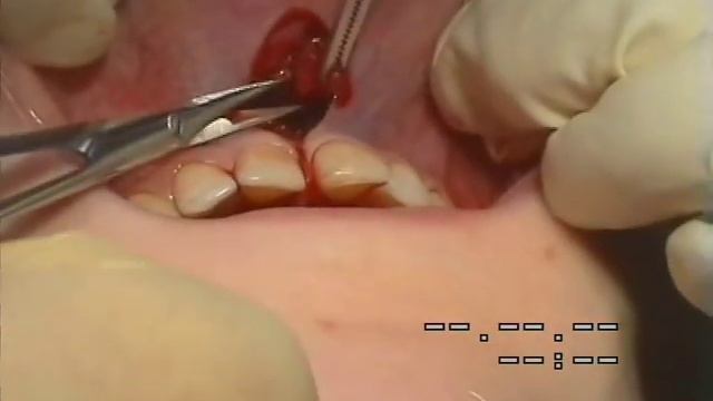 Френулопластика по Гликман испр..avi смотреть онлайн