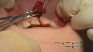 Френулопластика по Гликман испр..avi