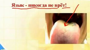 Причины белого налета на языке