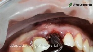 Straumann® BLX Immediate Incisor Placement and Loading. Step by step overview...