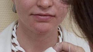 Медилайт изменение формы подбородка. Филлер для коррекции формы лица
